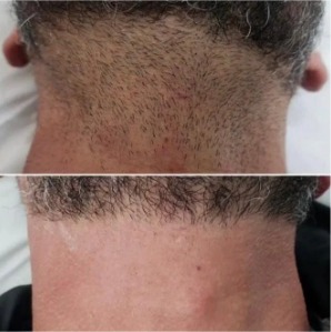 Depilação a Laser Faixa de Barba