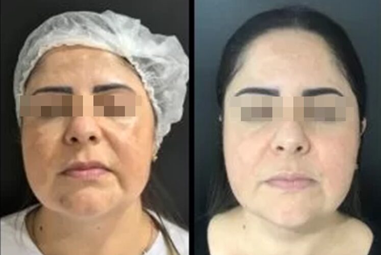 Lavieen para Melasma